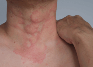 Tratamientos: cómo curar la urticaria