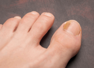 Onicomicosis
