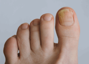 Tratamiento hongo onicomicosis