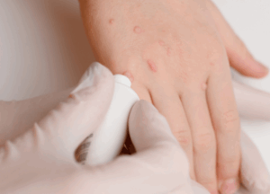 Tratamientos: cómo curar el VPH