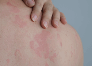 Urticaria