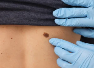 Eliminar queratosis seborreica en Madrid